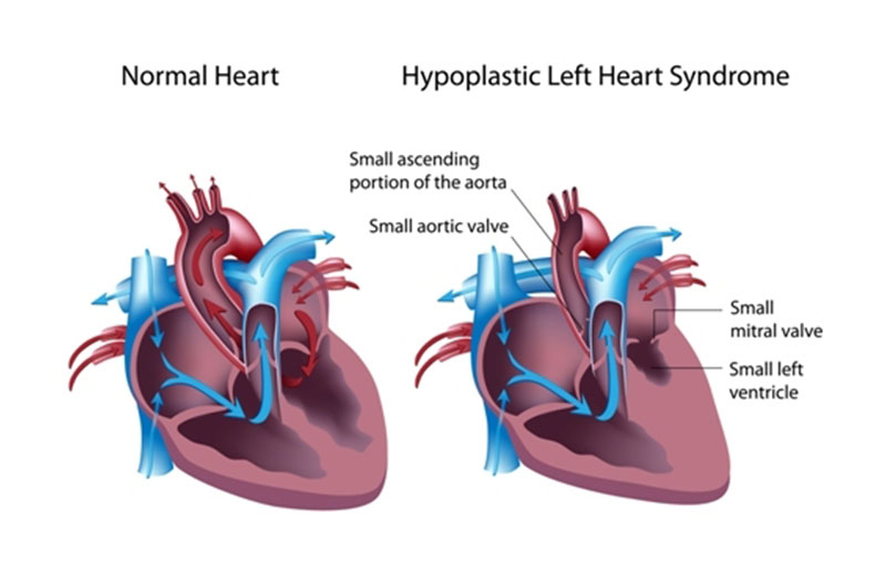 Atriyal Septal Defekt (ASD)