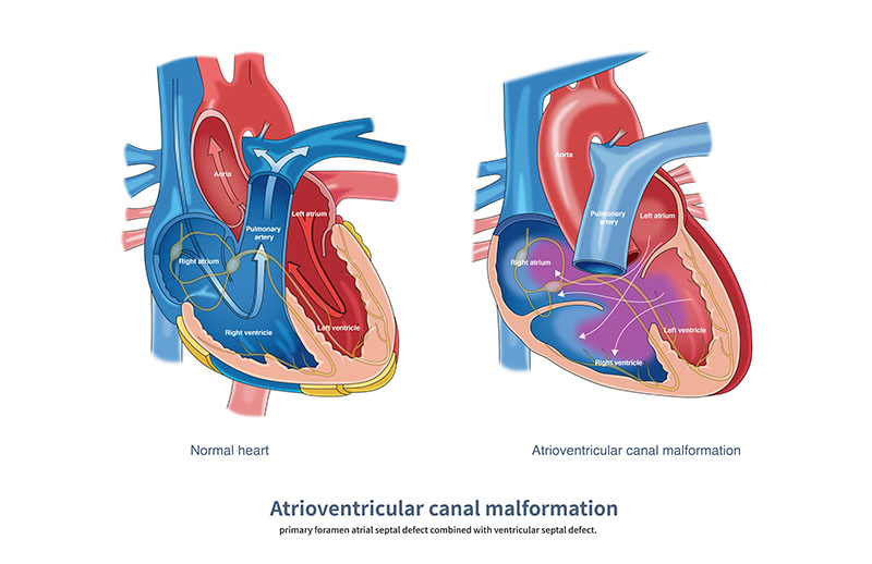 Atriyoventriküler Septal Defekt (AVSD)