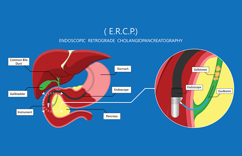 ERCP