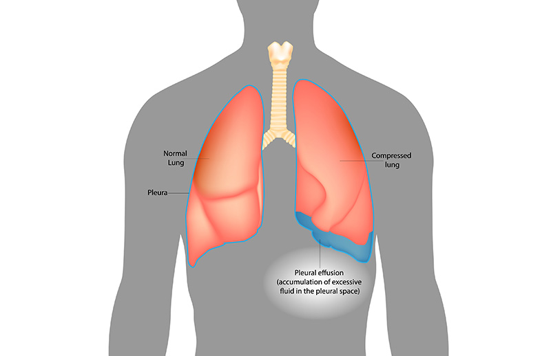 Göğüs Boşluğunda Sıvı Toplanması