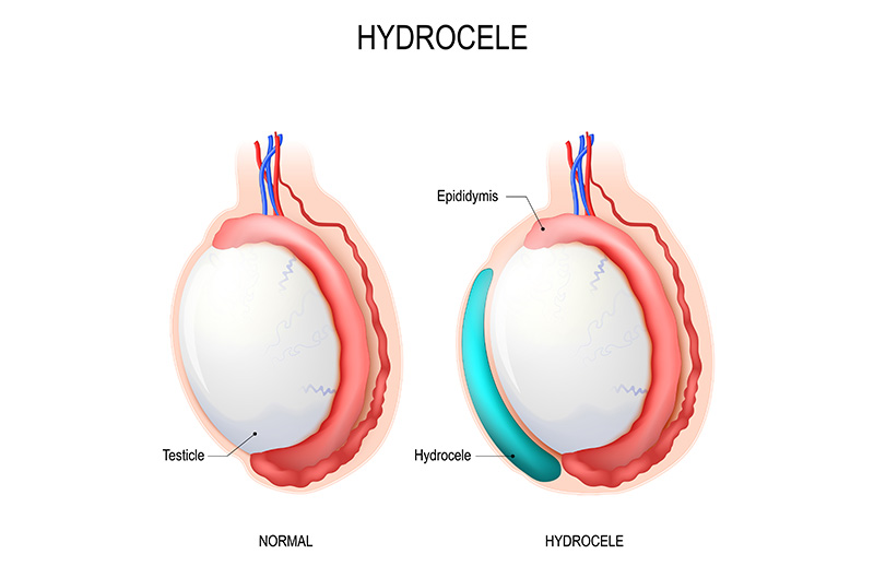 Hidrosel Ameliyatları