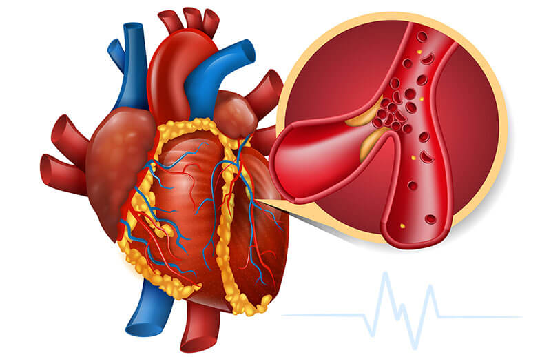 Koroner Arter Hastalığı