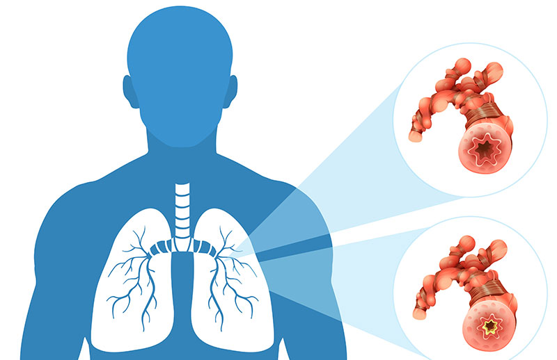 Obstrüktif Akciğer Hastalığı (KOAH)