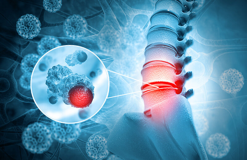 Spinal Tümör Ameliyatı