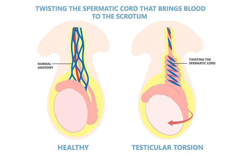 Testis Torsiyonu Ameliyatı