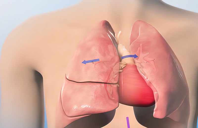 Total Pulmoner Venöz Dönüş Anomalisi (TAPVDA)