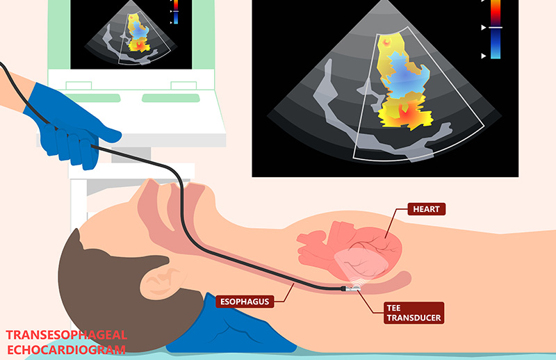 Transözefagial Ekokardiyografi