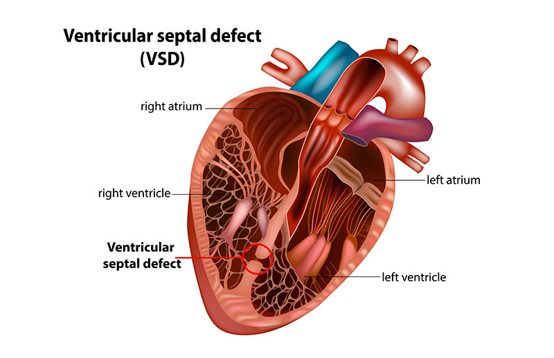 Ventriküler Septal Defekt (VSD)