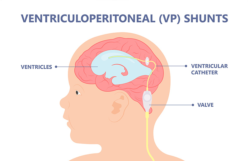 Ventrikülo Peritoneal Şantlama