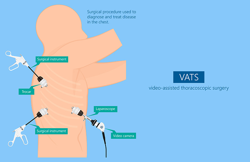 Videotorakoskopi (VATS)
